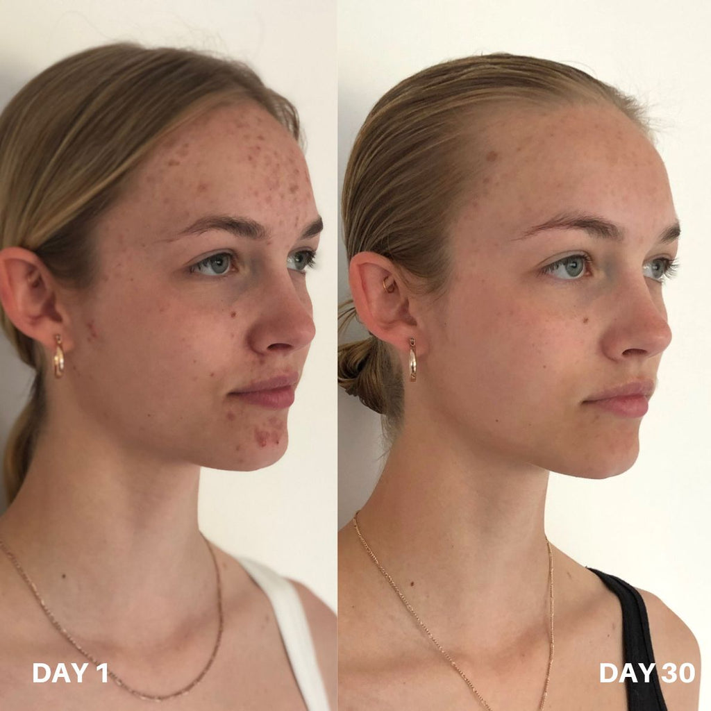 Clinisoothe+ — сравнение 1: кожа на ден 1 и ден 30