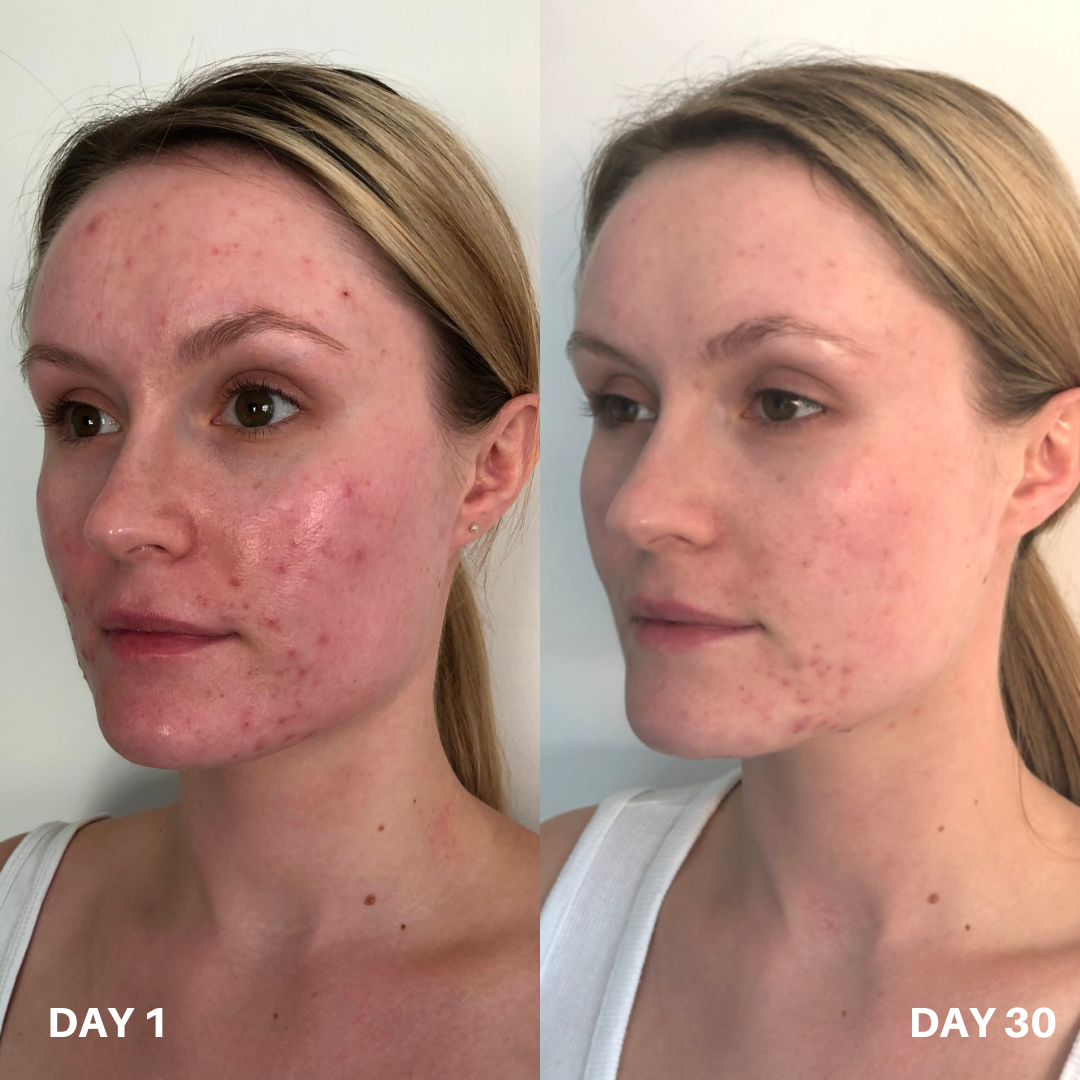 Clinisoothe+ — сравнение 4: кожа на ден 1 и ден 30