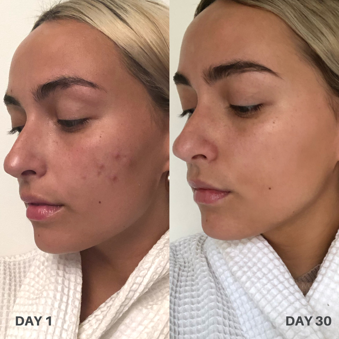 Clinisoothe+ — сравнение 6: кожа на ден 1 и ден 30