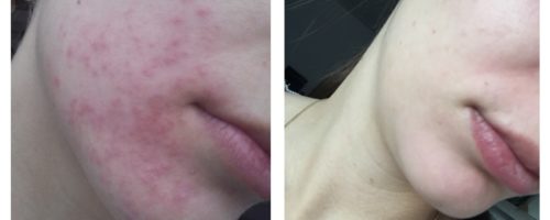 pimples-and-red-spots pimples-and-red-spots