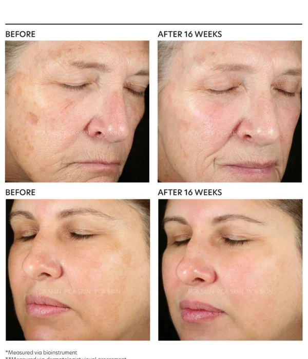 Pigment Gel® Pro - професионален серум при пигментации