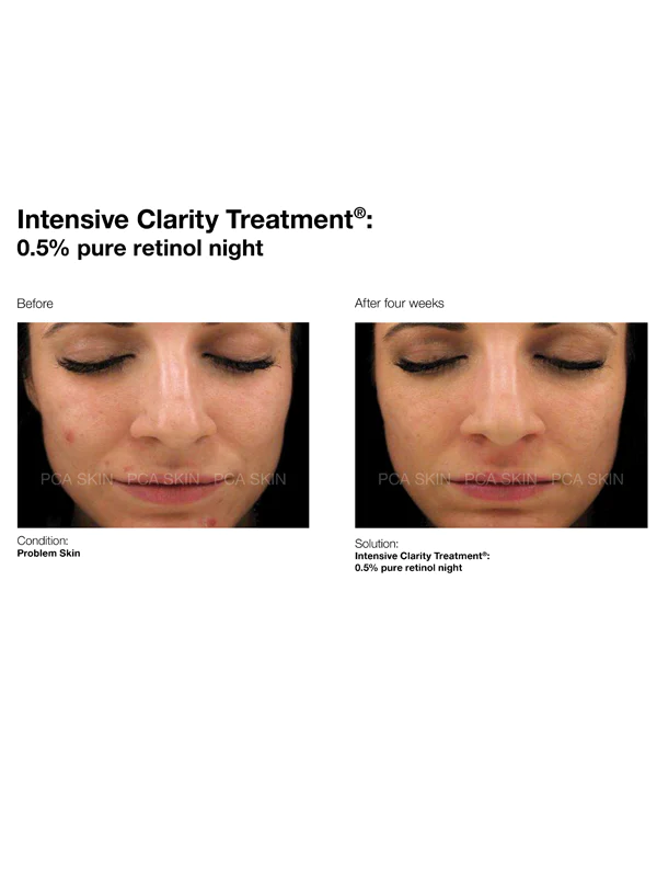 Терапия с ретинол при акне Intensive Clarity Treatment®: 0.5% retinol & salicylic acid - PCA SKIN